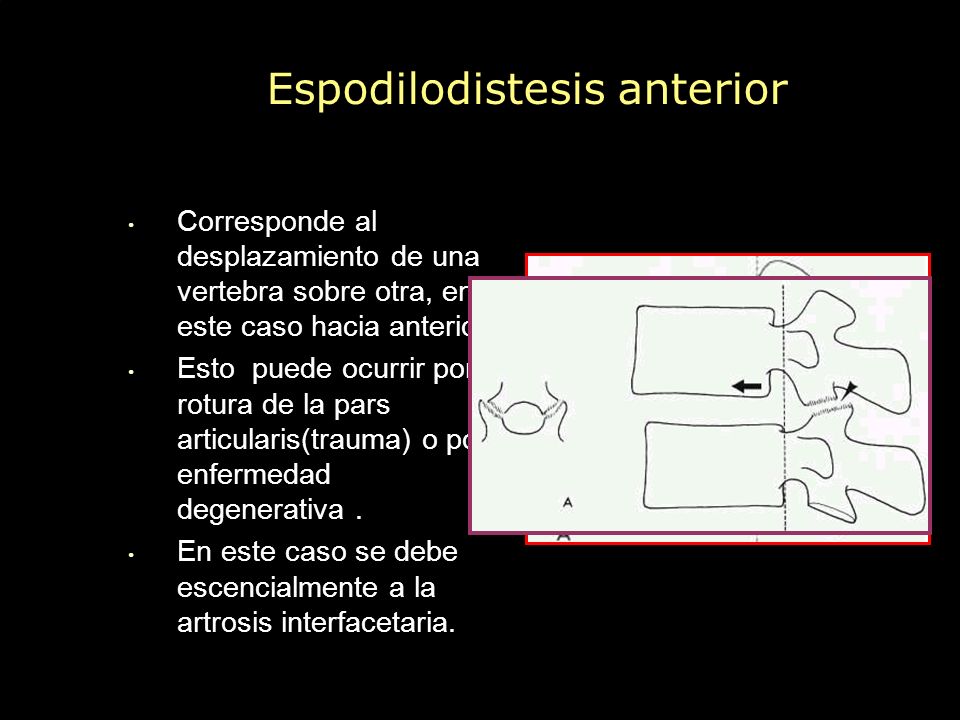 Los medios ortopédicos para el tratamiento de la osteocondrosis